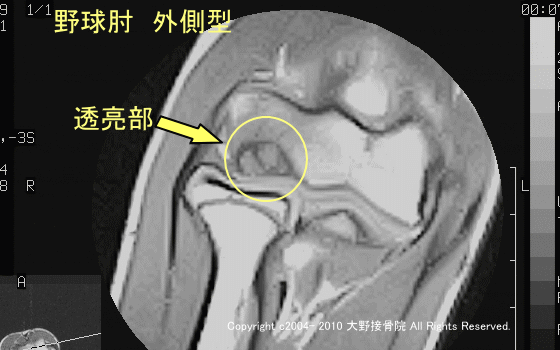 「上腕骨小頭離断性骨軟骨炎」透亮期の野球選手のMRI画像